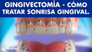 Tratamiento de la sonrisa gingival - Gingivectomía © 