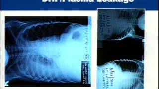 Demystifying Medicine 2015 - Dengue: Breakbone Fever: a Major Unpublicized Killer Disease