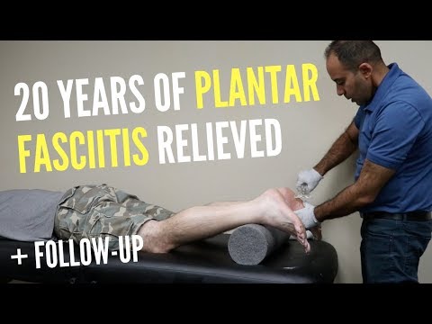 20 Jahre Plantarfasziitis mit ASTR gelindert (+Nachuntersuchung!!!)