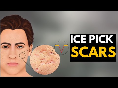 All About Allergy Shots