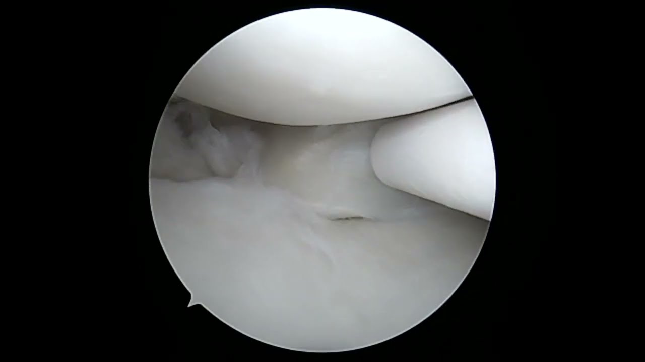 Meniscus Repair with new Fiberstitch