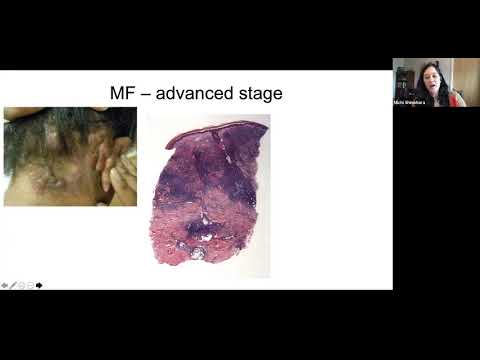 Pathology Grand Rounds - Cutaneous T-Cell Lymphoma | Dr. Michi Shinohara