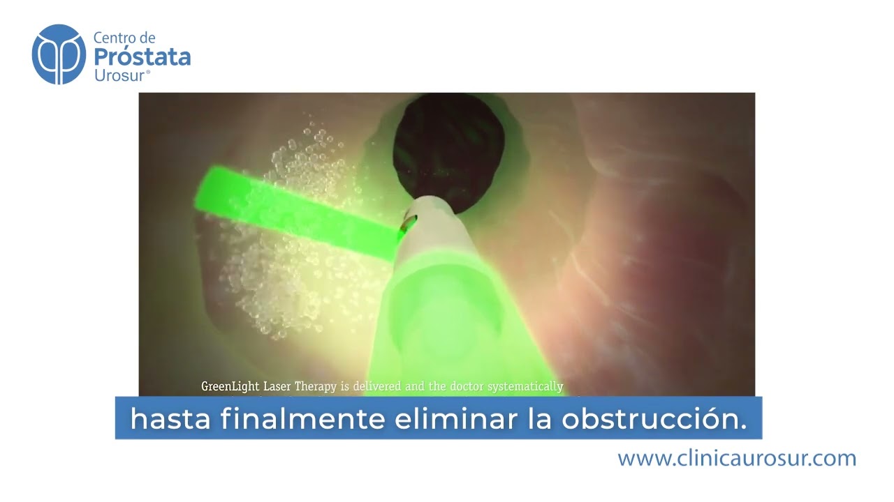 Fotovaporización de próstata con láser verde