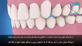 جراحی انتهای ریشه | سیمادنت