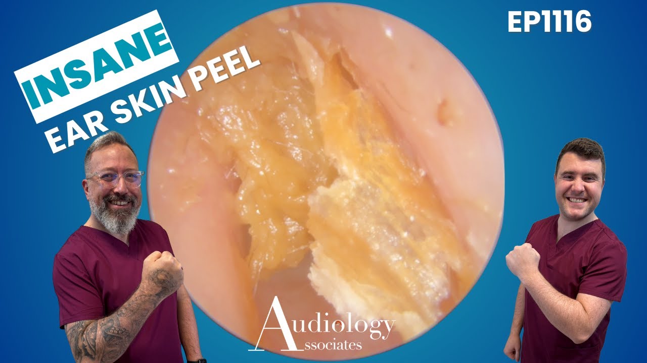 INSANE Ear Skin Peel! Satisfying Deep Layer Removal 👂😱 - EP1116