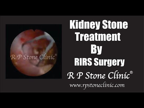 Kidney Stone Treatment by RIRS Surgery
