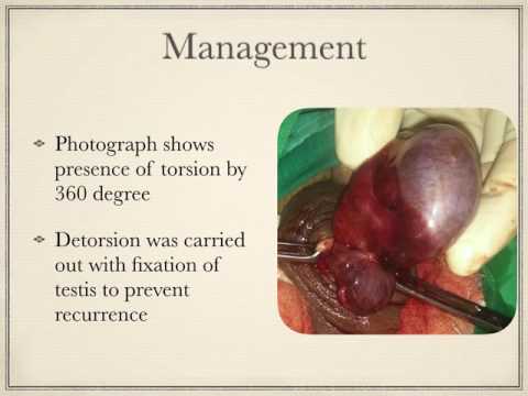 Torsion Testis: Surgical Emergency in Children 