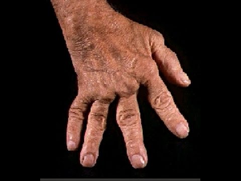 Creme von Rückenschmerzen während der Schwangerschaft Walnuss Wände und Gelenke