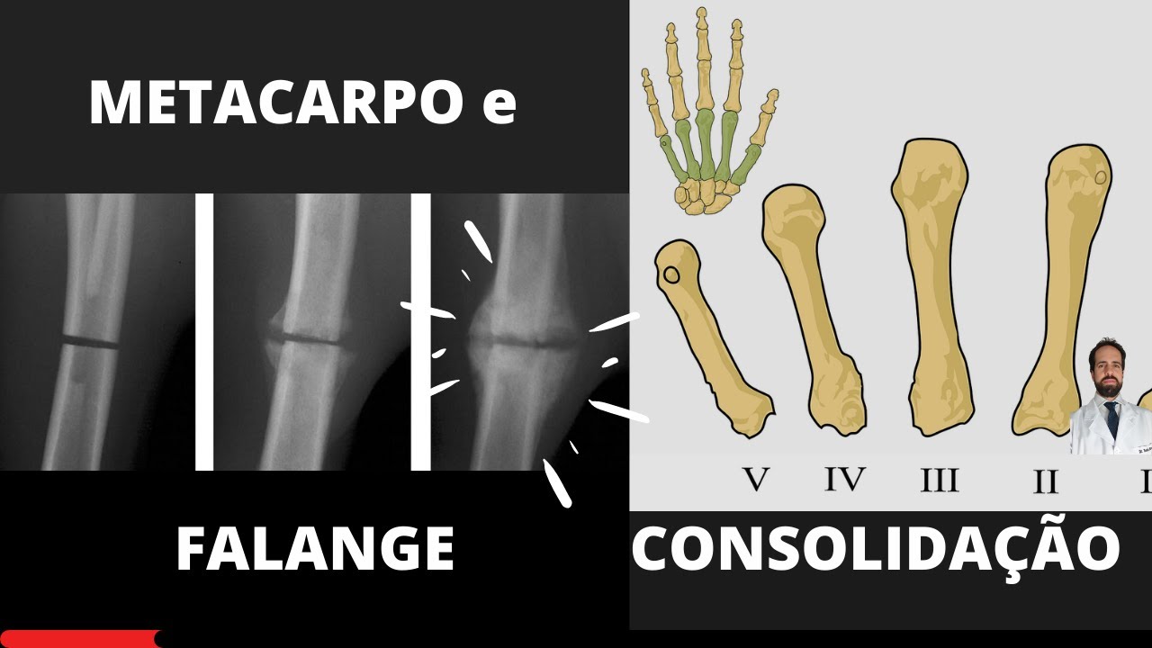 Quanto Tempo para Consolidar as Fraturas de Metacarpo e Falange?