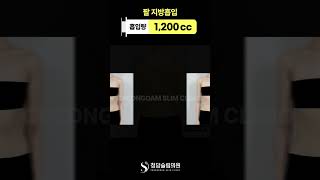 팔 지방흡입 효과 어때요?