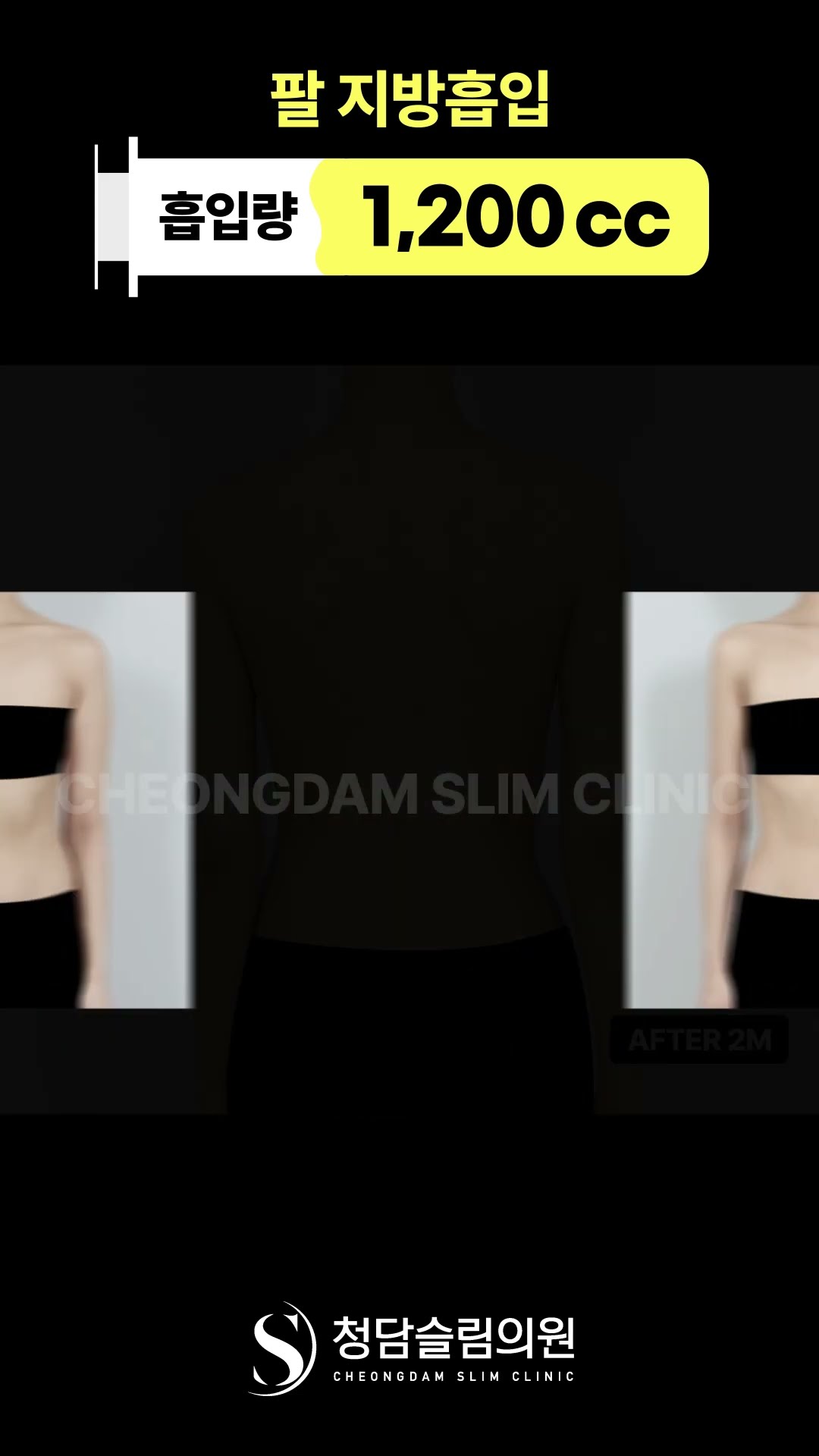 팔 지방흡입 효과 어때요?
