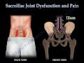 Sacroiliac Joint Dysfunction Animation - Everything ...