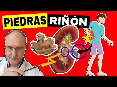 CÁLCULOS RENALES: Síntomas, Causas y Tratamiento de la LITIASIS RENAL (Piedras en el Riñón)