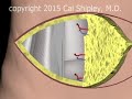 Breast Reconstruction - DIEP procedure Narration and Animation by Cal Shipley, M.D.