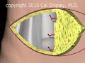 Breast Reconstruction DIEP Procedure Narration And Animation By Cal Shipley M D