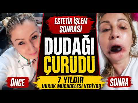 Güzelleşmek İsterken Hayatı Karardı! İşlem Sonrası Dudağı Çürüdü