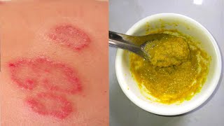 How to get rid of ringworm marks permanently with this mix at home | 100% working