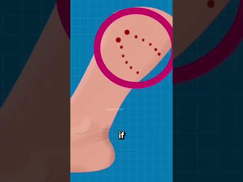 Snake Bite That Looks Harmless