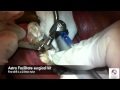 Immediate Implant and Provisional #8 Using GALILEOS Guided Surgery
