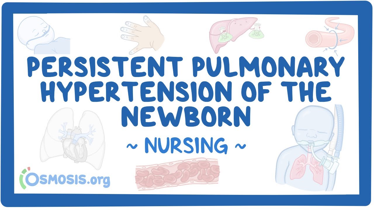 Persistent pulmonary hypertension of the newborn (PPHN): Clinical Nursing Care