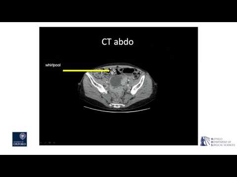 Oxford University surgical lectures: the disorders associated with the mesentery