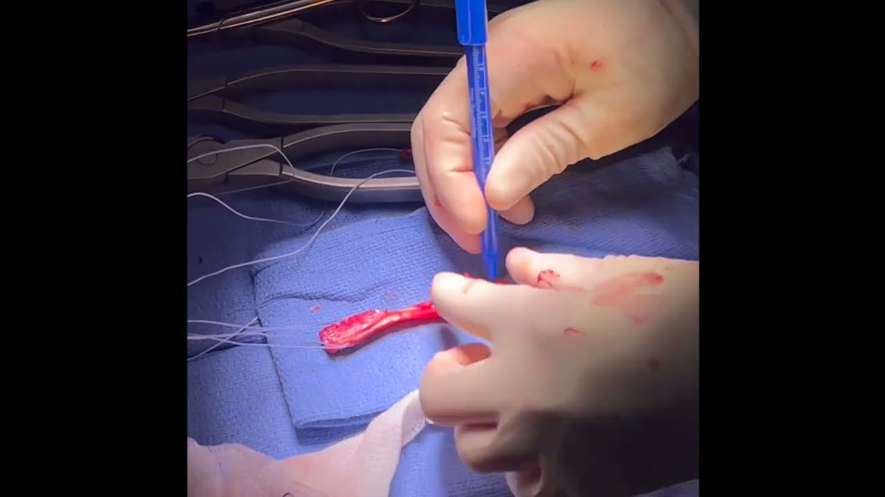 ACL Patella Tendon Reconstruction with Tightrope and Internal Brace.