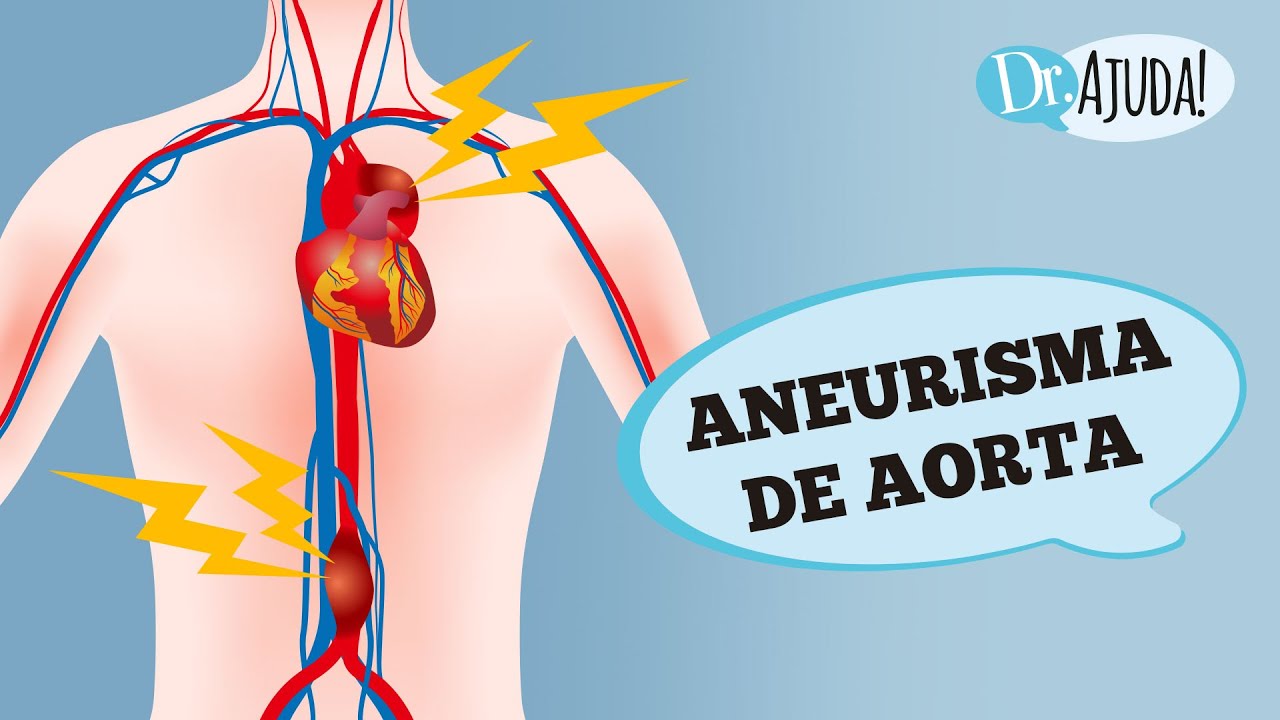 ANEURISMA DE AORTA: O QUE É? SINTOMAS E TRATAMENTO