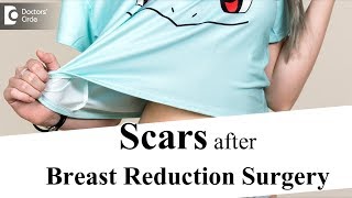 Will breast reduction procedure leave scars? - Dr. Srikanth V