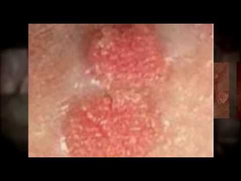 Gyulladásos kenet papillomavírus