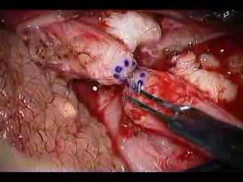 Vasectomy Reversal 