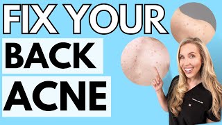Fix Your Back Acne! | 3 Easy Tips To Clear Your Skin