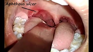Canker Sore or Aphthous ulcer or Common Mouth ulcer