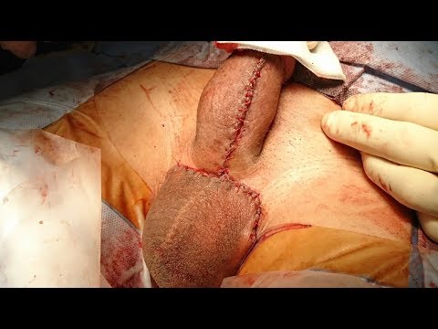 Helyreáll-e az erekció a műtét után