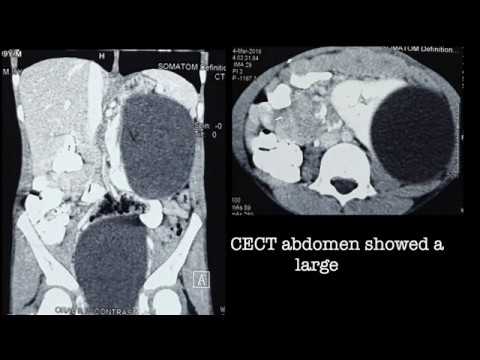 Laparoscopic Excision of Renal Hydatid using Port-In-Cyst Technique