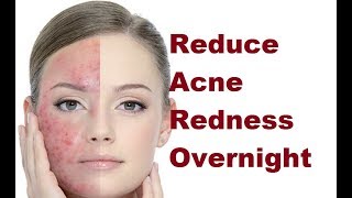 How to Reduce Pimple and Acne Redness Overnight