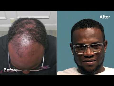 Amazing FUE Hair Transplant on African American Male -...