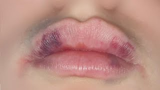 how to get rid of bruised lips from suction