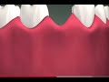 Dental implant surgery | Our Whisper Matters