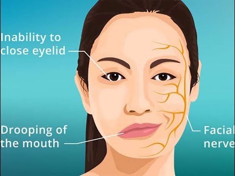 6 sinjalet që paralajmërojnë se mund të pësoni një paralizë!