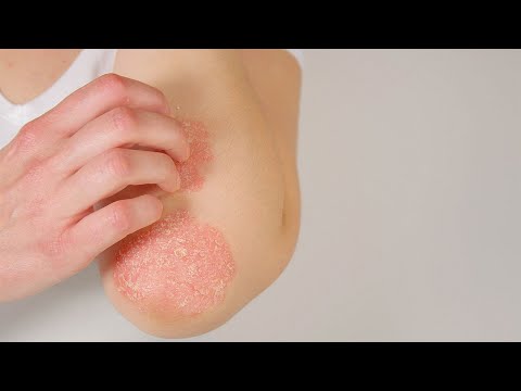 Cura contro aridità di pelle per dermatite atopic Unguento di psoriasi con boligolovy