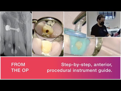 LIVE GentleWave Procedure – Anterior Tooth
