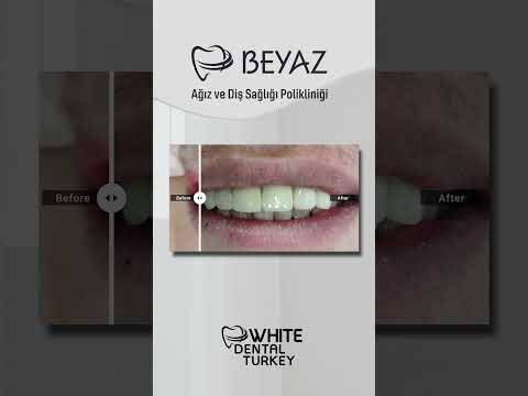 En Son Gülüş Tasarımı Tedavilerimizi İnceleyin