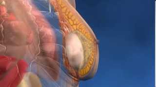 Tipos de prótesis para aumentar el pecho - Clinica Menorca