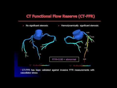 Hemodynmaic Significance of Coronary Stenosis in Patients with Chest Pain