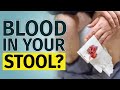 BLOOD IN STOOL Other Signs You Have To Check