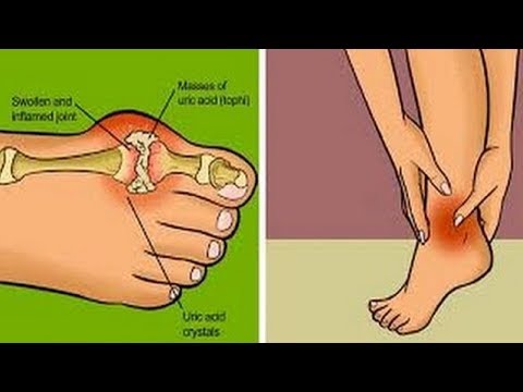 Osteoarthritis des Handgelenks von 1 Grad Stechender Schmerz in der Rückseite des hinteren rechten es
