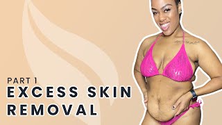 Bryanna's Journey | The Consultation and AbEX Tummy Tuck Alternative Pre-Op