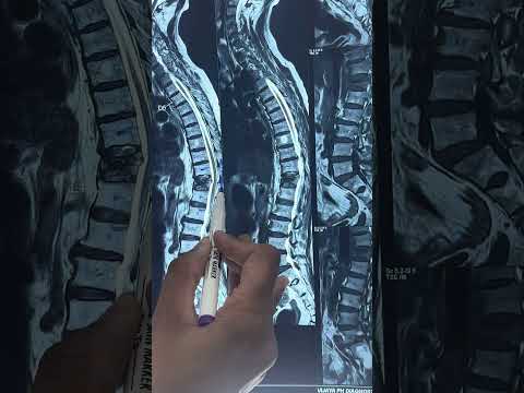What is spine vertebroplasty ? How is it done ? Which cases need vertebroplasty | Dr.Ajay Kothari