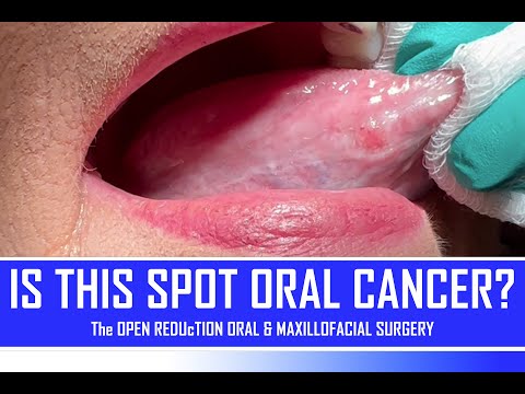 Is This Spot Oral Cancer?? | How To Identify Oral Cancer