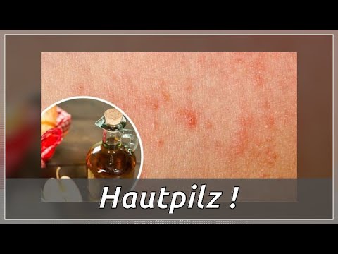 Opistorchos und die Schuppenflechte Mit dem Ekzem rufen nicht